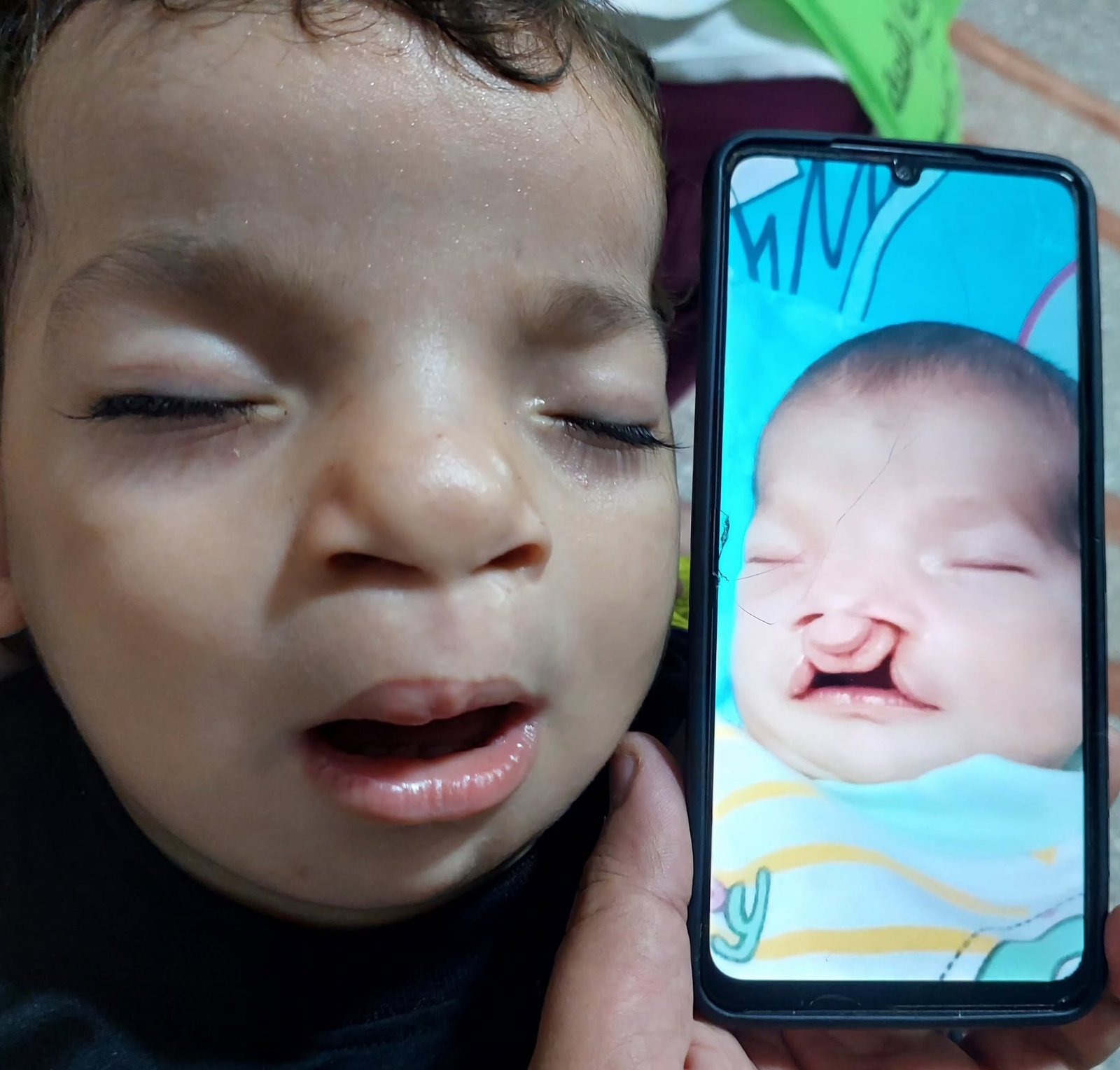 الصورة الأصلية المنشورة: الطفل بعد الإصلاح وبجواره هاتف يعرض صورته قبل العملية